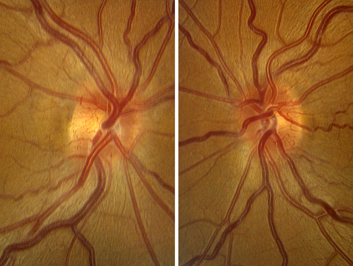 Long-term safety of gene therapy is a critical consideration, with potential risks of immune responses, off-target effects or unintended consequences of gene insertion. Over five years, 124 intraocular inflammation events occurred in the injected eyes, with 94% observed in the first two years.