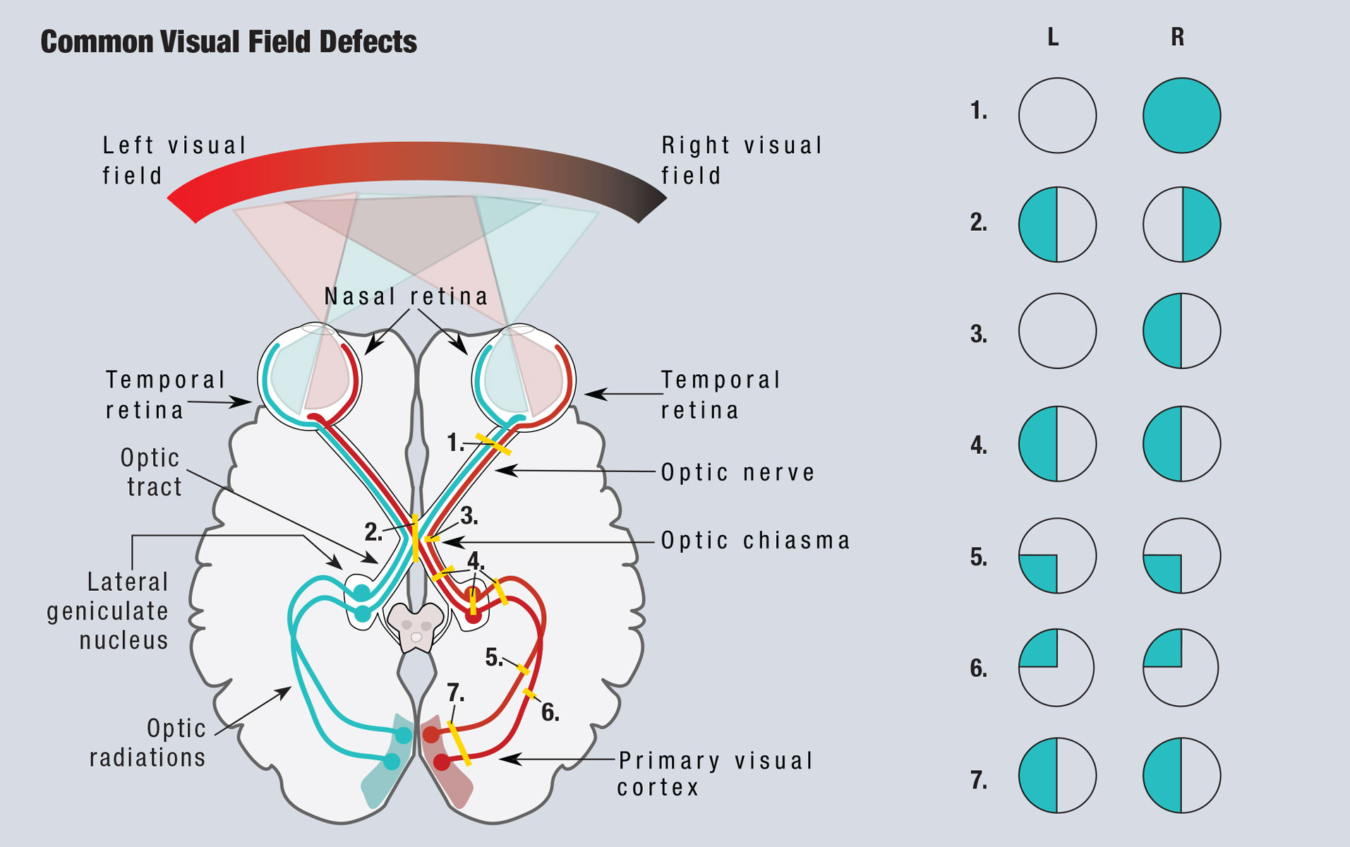 Binocular visual field loss increases the risk of getting into a car accident, and approximately 23%of subjects in this study were involved in more than one incident.
