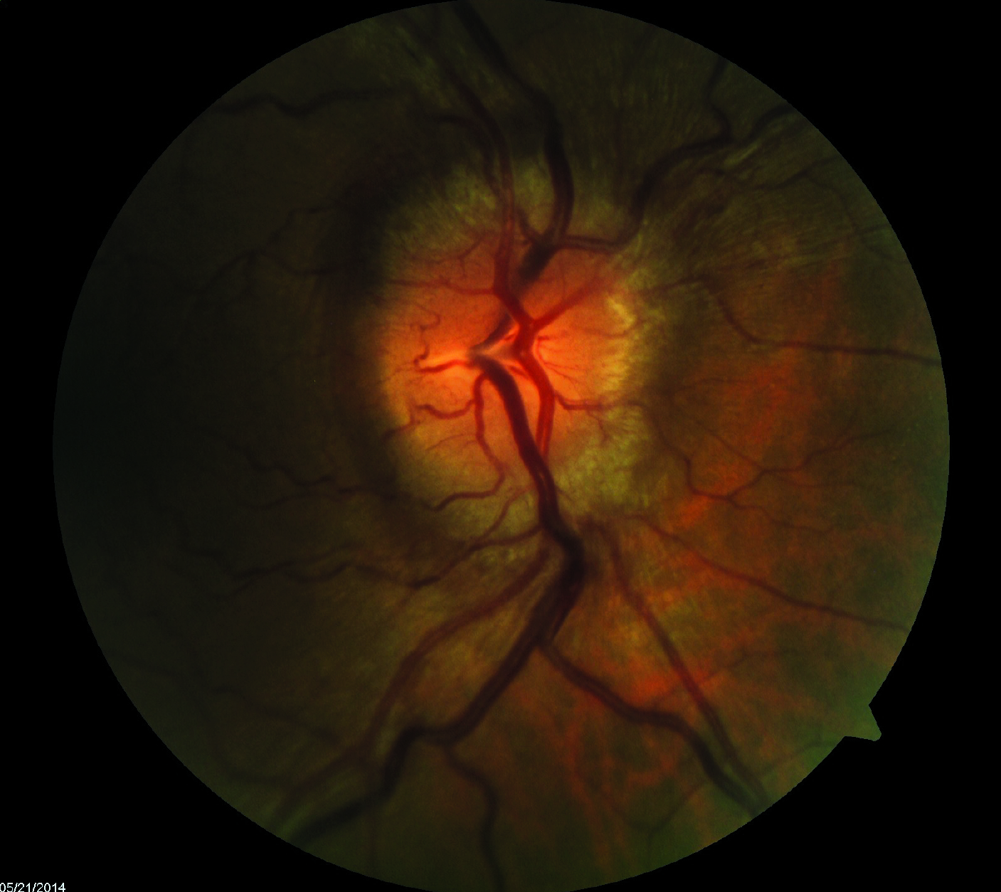 A recent study published in Journal of Neuro-Ophthalmology explores the heightened risk of kidney stones in IIH patients treated with CAIs. The retrospective analysis of over 44,000 patients revealed a consistent increase in kidney stone formation, especially in male patients. This finding underscores the need for clinicians to adopt tailored treatment approaches, particularly for those with a history of kidney stones or at higher risk.