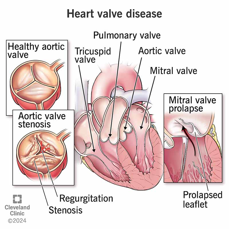 Patients with AMD have a higher prevalence of VHD and are more likely to undergo a heart valve–related procedure compared to patients without AMD, with no difference between patients with SDDs and patients without SDDs.