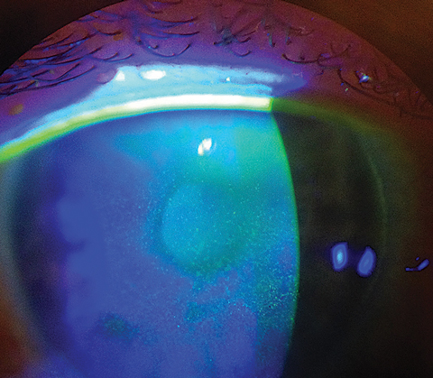 Prior research suggests Asian individuals may have severe signs of DED but without proportionate symptoms, possibly due to physical variations in ocular anatomy.
