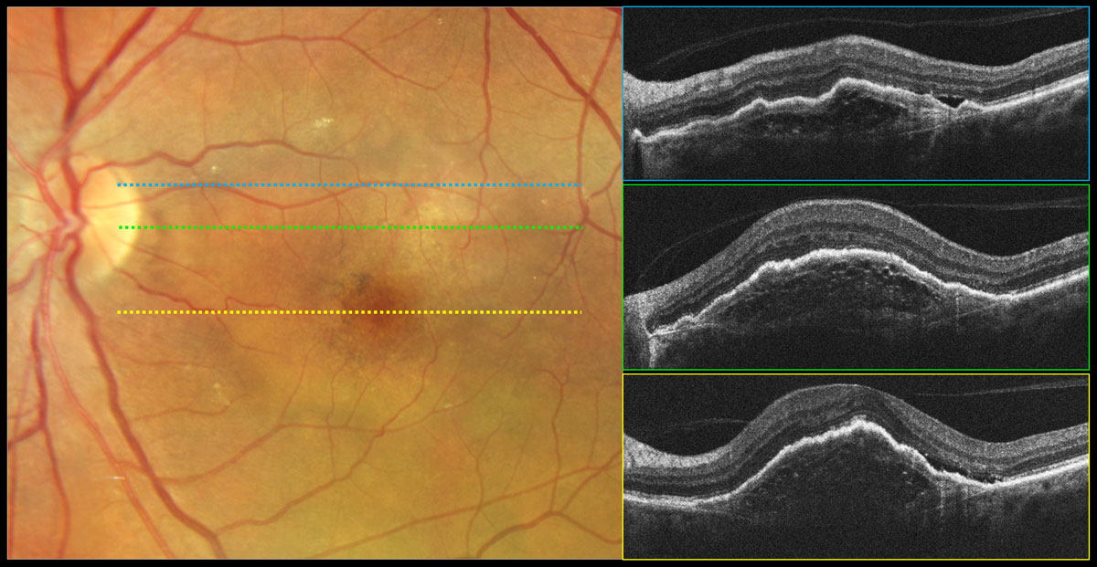 This global survey of more than 6,000 people in 24 countries provides new and important insights into the breadth and depth of the challenges and opportunities in the optimal delivery of care and management of patients with wet AMD. Addressing these challenges in the healthcare community can all serve to improve vision outcomes for patients and ultimately quality of life.
