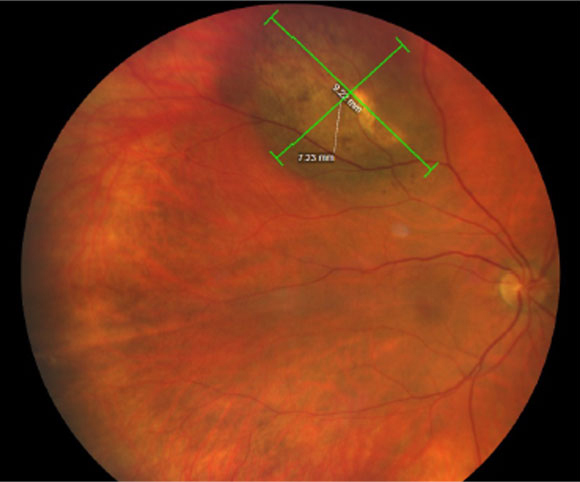 The authors discuss in their writing that many known risk factors like white race, light skin and eye color suggest an important role of UV light exposure in UM pathogenesis.