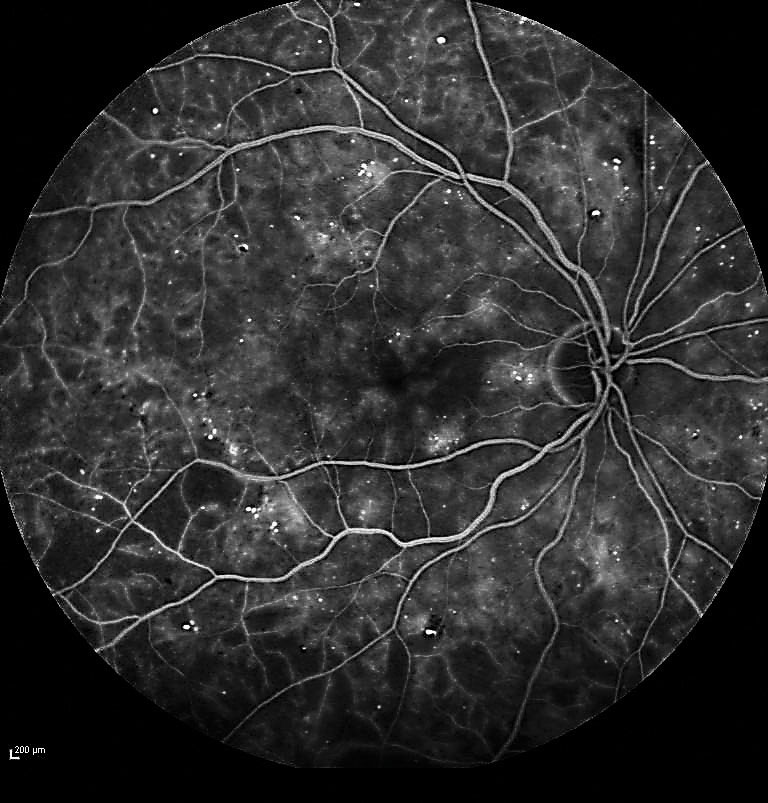 Further research into sociodemographic and cultural factors influencing diabetic eye disease and access to ophthalmic care will be crucial for the prevention of DR and improving vision outcomes.