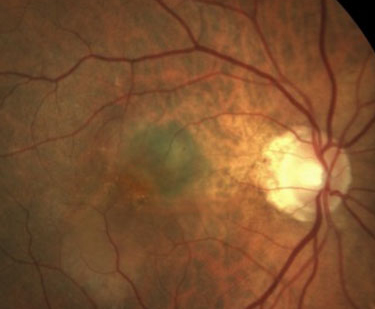 A recent study published in Eye investigates the demographic representation in clinical trials for AMD. While female subject enrollment was found to align with the burden of disease, the study revealed a notable underrepresentation of racial and ethnic minorities, including Black, Hispanic, and Asian participants. The findings stress the importance of ensuring diverse enrollment in future AMD trials to enhance the generalizability of treatment outcomes and address health equity in ophthalmic research.