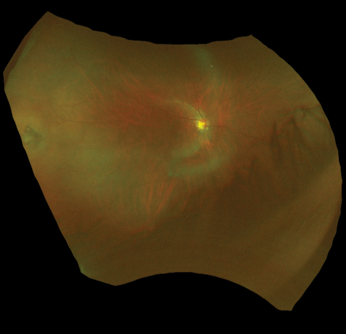 Lesion at nine o’clock was diagnosed as CHRPE on this visit and subsequent visits.