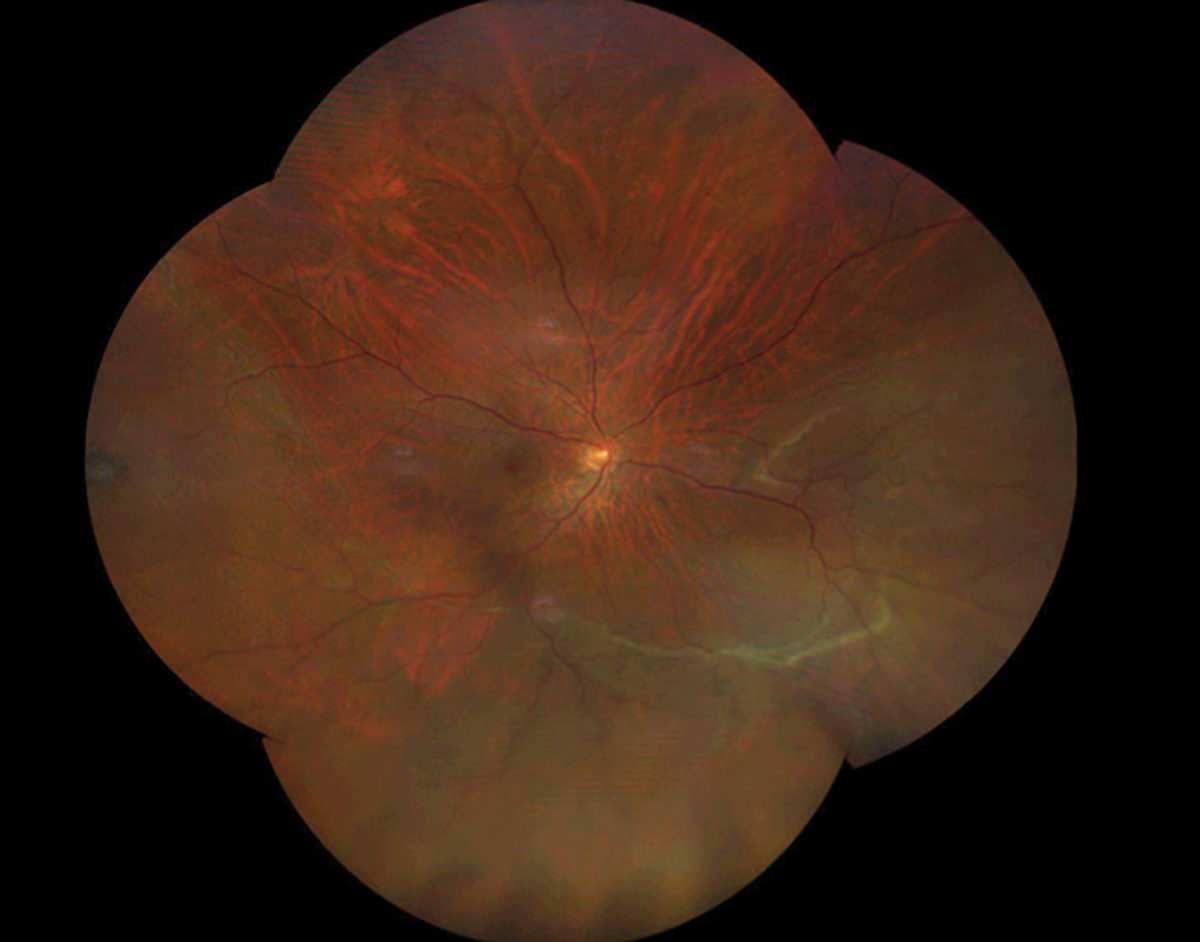 UWF image taken the day the detachment was diagnosed by the retina surgeon. The lesion at nine o’clock was diagnosed as a retinal tear that resulted in the retinal detachment.