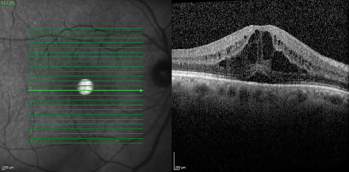 Cystoid macular edema should always be ruled out if best-corrected vision postoperatively does not meet preoperative potential.