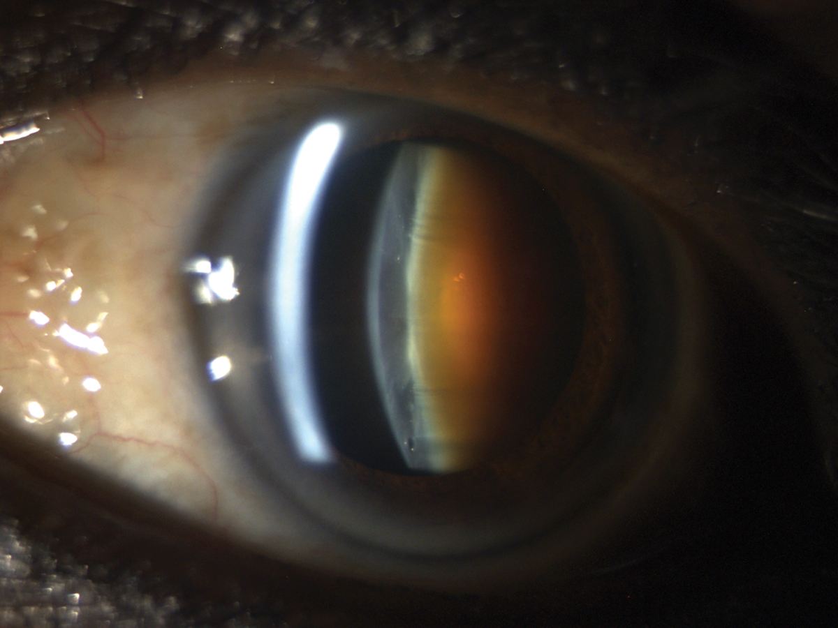 Patients with dense cataracts are at higher risk of posterior capsular rupture.