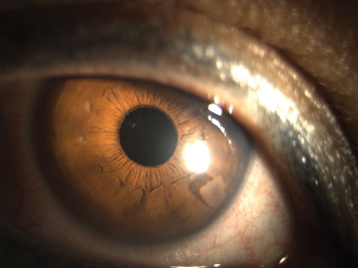Small nuclear fragment in anterior chamber.