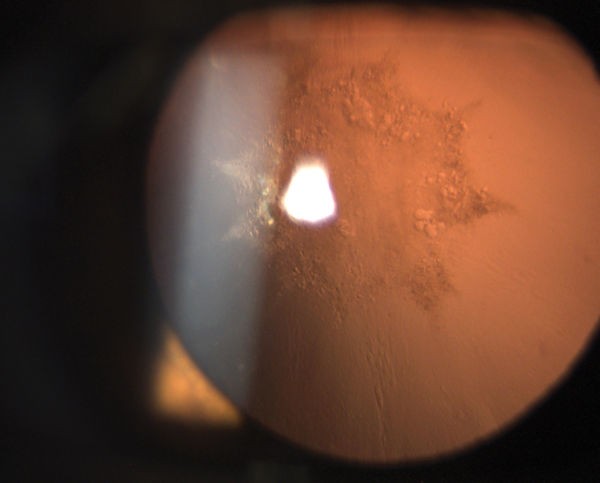 Posterior subcapsular cataracts increase the risk of PCO.