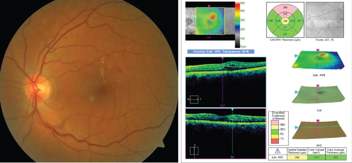 Fig. 1. Example of a patient with diabetic macular edema. The OCT results (right) demonstrate an area of retinal thickening superior to the central subfield and corresponding to the area of hard exudates on the left.