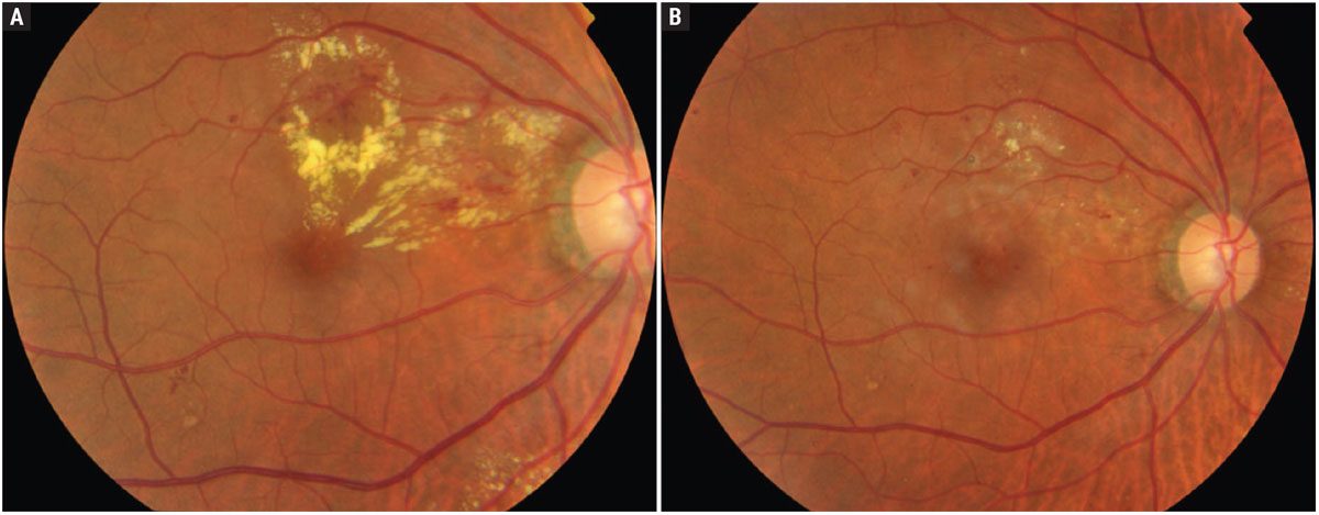 Fig. 2. Clinically significant macular edema before (A) and after (B) focal laser photocoagulation. From the publication of ETDRS until the advent of anti-VEGF therapies, this approach was routinely undertaken.