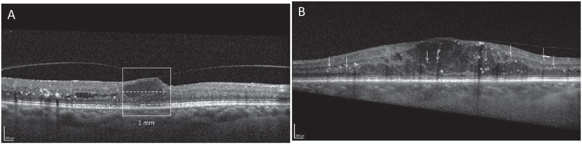 Fig. 3. Contemporary thinking on DME is such that “watchful waiting” may be appropriate in cases with good visual acuity. However, if inflammatory biomarkers such as (A) disorganization of retinal inner layers or (B) retinal hyperreflective foci are present, the patient may be suitable for referral to a retina specialist even in the absence of visual changes.
