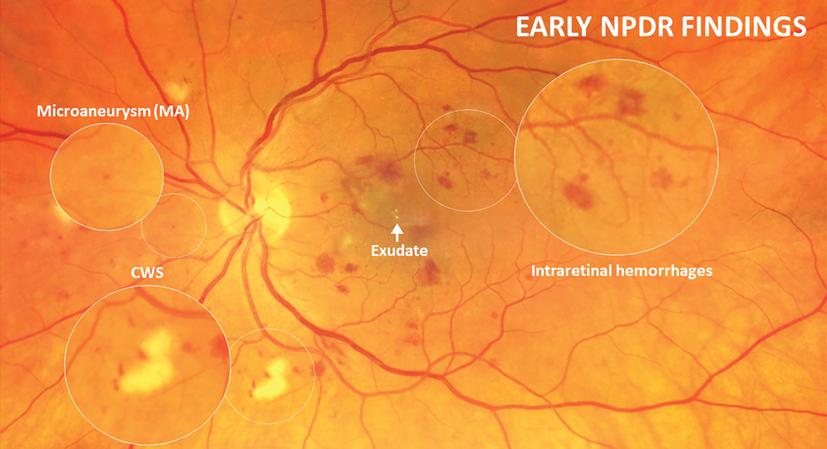 With the updated ICDR guidelines, mild retinopathy is classified as microaneurysms only and the presence of intraretinal hemorrhages is indicative of at least moderate NPDR stage.
