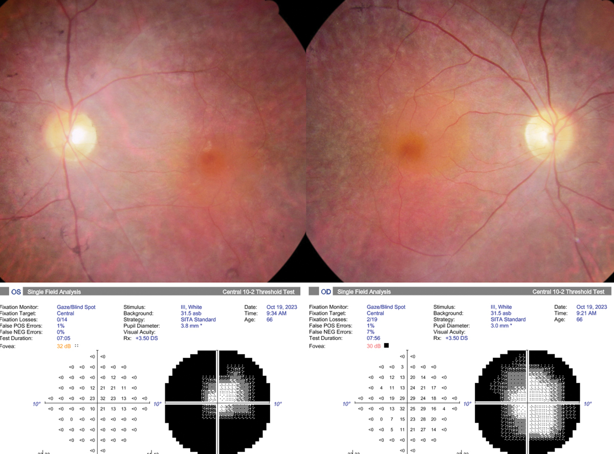 Fundus photograph and automated 10-2 visual field of the right and left eye.