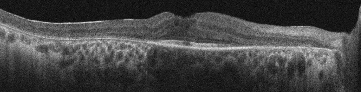 SD-OCT of the right macula demonstrating cystoid macular edema, epiretinal membrane and parafoveal ellipsoid zone loss.