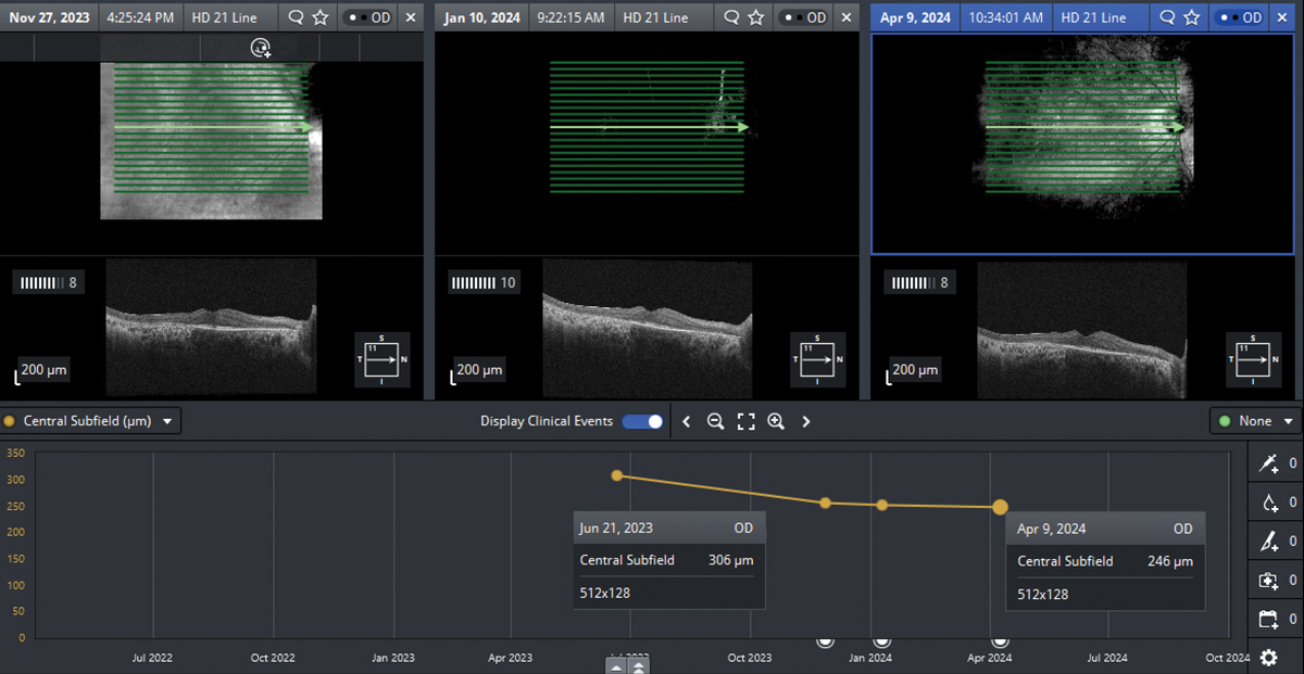 Reduction in central subfield thickness in the right eye following initiation of dorzolamide 2% three times daily.