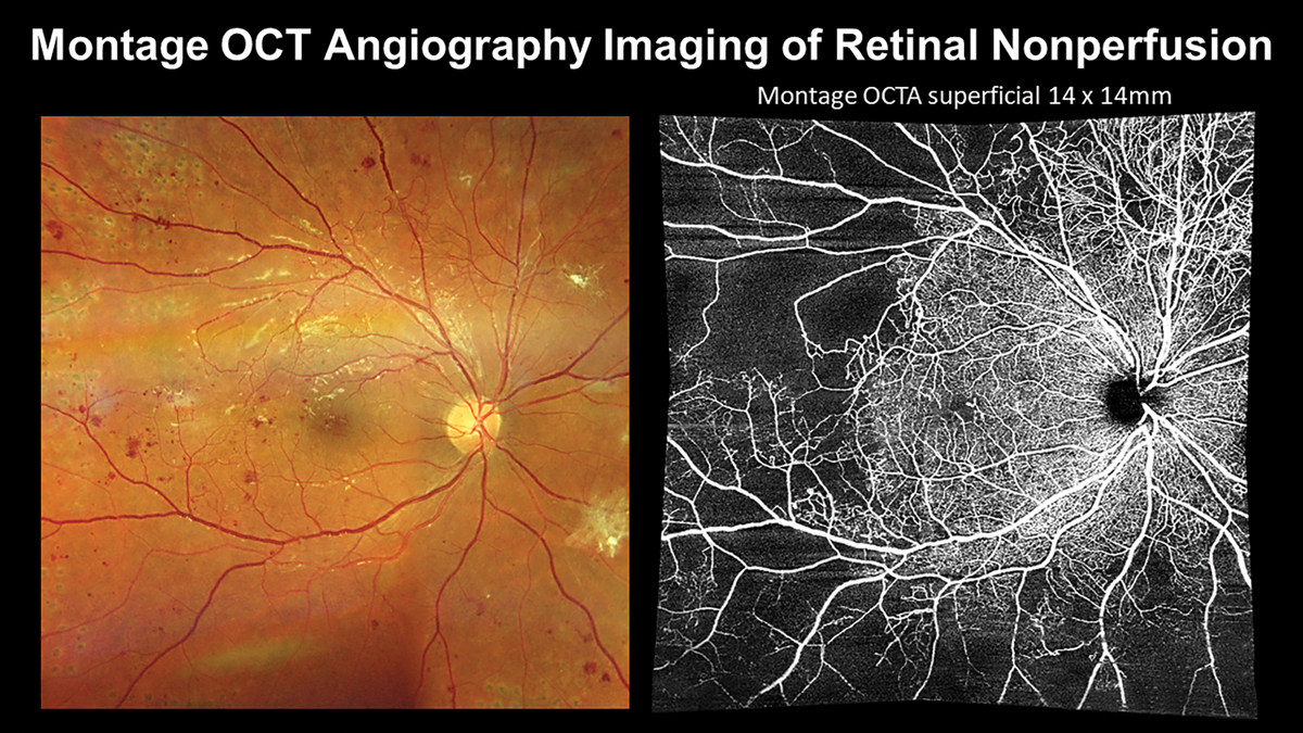 Incorporating montage OCT-A enables visualization of retinal nonperfusion that may be nearly invisible with ophthalmoscopy or color photography alone.