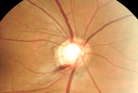 Office-based BP measurements cannot sufficiently and accurately predict individuals with the lowest BP values identified using 24-hour BP recording, leading the study authors to argue for its use in patients at risk of glaucoma progression, particularly those who demonstrate optic disc hemorrhage.