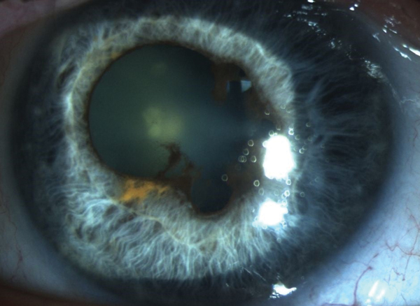 Can You Spot these Drug-induced Ocular Side Effects?