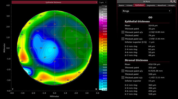 Epithelial and stromal mapping by SS-OCT may be an important diagnostic tool in the detection of morphological changes associated with dry eye.