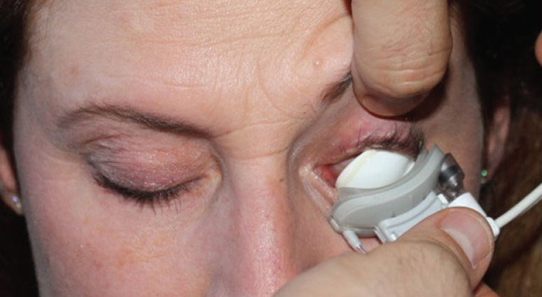 LipiFlow improved symptoms and meibomian gland function, even though outcomes were not significantly different from other dry eye disease treatments.