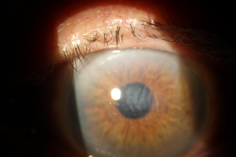 Alterations in proinflammatory cytokines might be the underlying cause of persistent anterior chamber inflammation after cataract surgery.