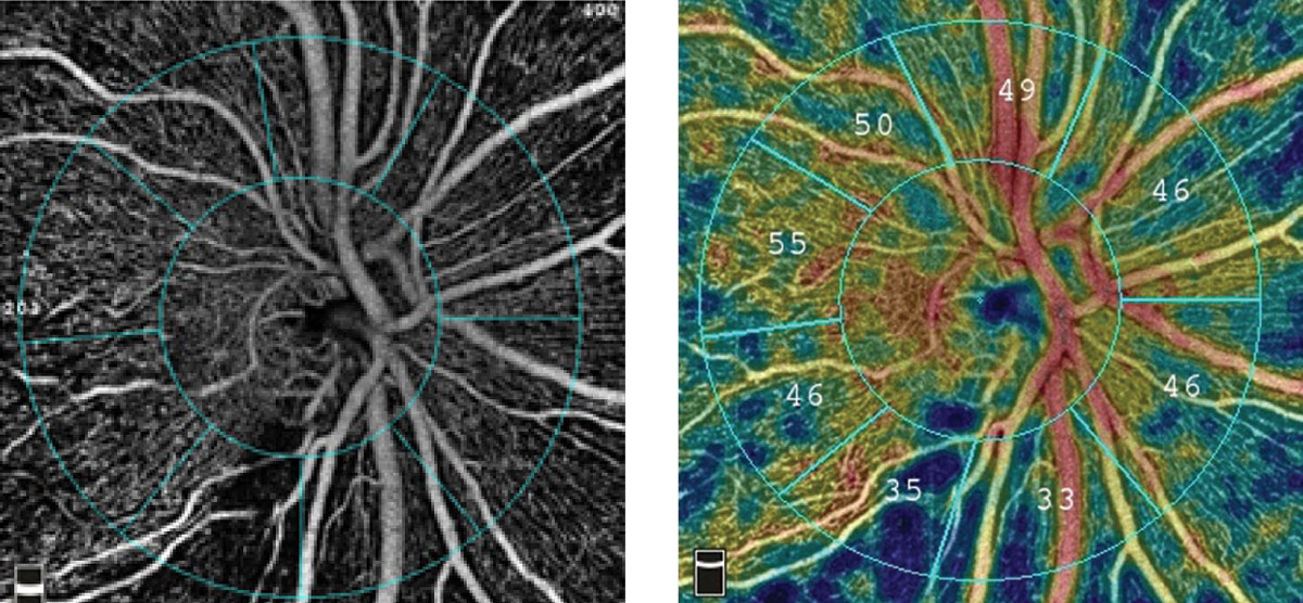 A cohort of 66 patients with newly diagnosed open-angle glaucoma had an average IOP reduction of around 30% after one month of treatment with latanoprostene bunod 0.024% drops. Even more interestingly, patients also showed improved vessel density in different quadrants in all OCT-A slabs. 