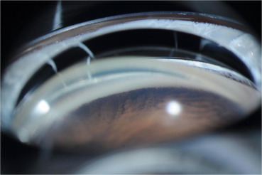 This analysis of the IRIS registry found that children with glaucoma were more likely to receive incisional surgery if they have a higher baseline IOP or a younger age at diagnosis. The most common first-recorded procedures were angle surgery for primary congenital glaucoma, tube shunt surgery for glaucoma following cataract surgery and secondary glaucoma and SLT for juvenile open-angle glaucoma.