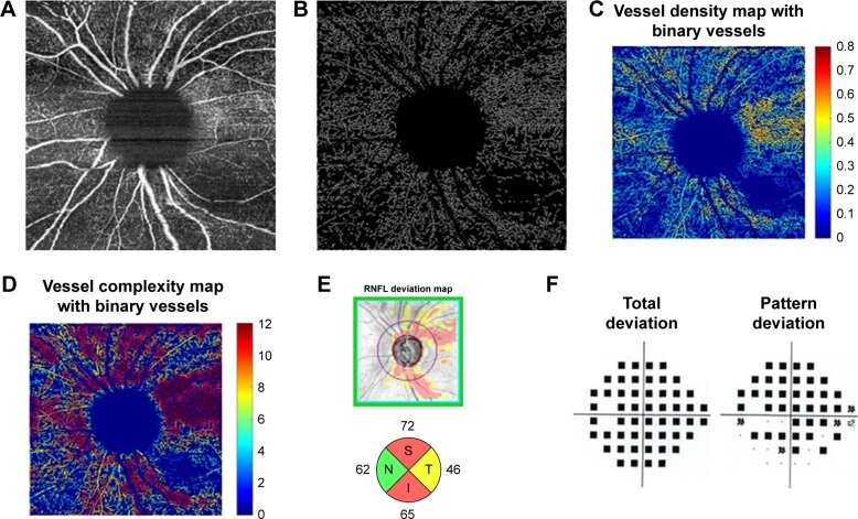 These OCT-A images from a different study show the process of vascular skeleton density measurement in glaucoma and correlation with visual field results: (A) En face image. (B) Skeletonized vessel image with large vessels removed. (C) Vessel density map with binary vessels showing areas of higher vessel density in warmer colors. (D) Vessel complexity map with binary vessels showing areas of greater vessel branching in warmer colors. (E) OCT RNFL deviation map and RNFL thickness by quadrant. (F) Probability total and pattern deviation maps.