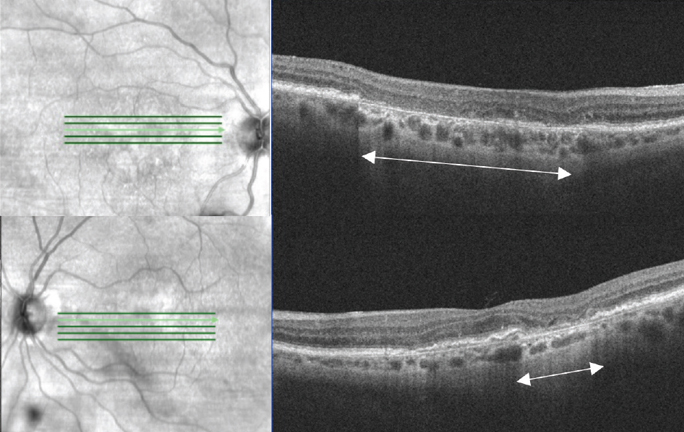 Some outcomes, including key endpoints of microperimetry average threshold and atrophic lesion size, indicate that PPS toxicity in many cases may be a relentlessly progressive degenerative maculopathy. These findings should inform PPS prescribing patterns, patient counseling and disease monitoring strategies. One key feature to look for is cRORA (seen here in a GA patient).