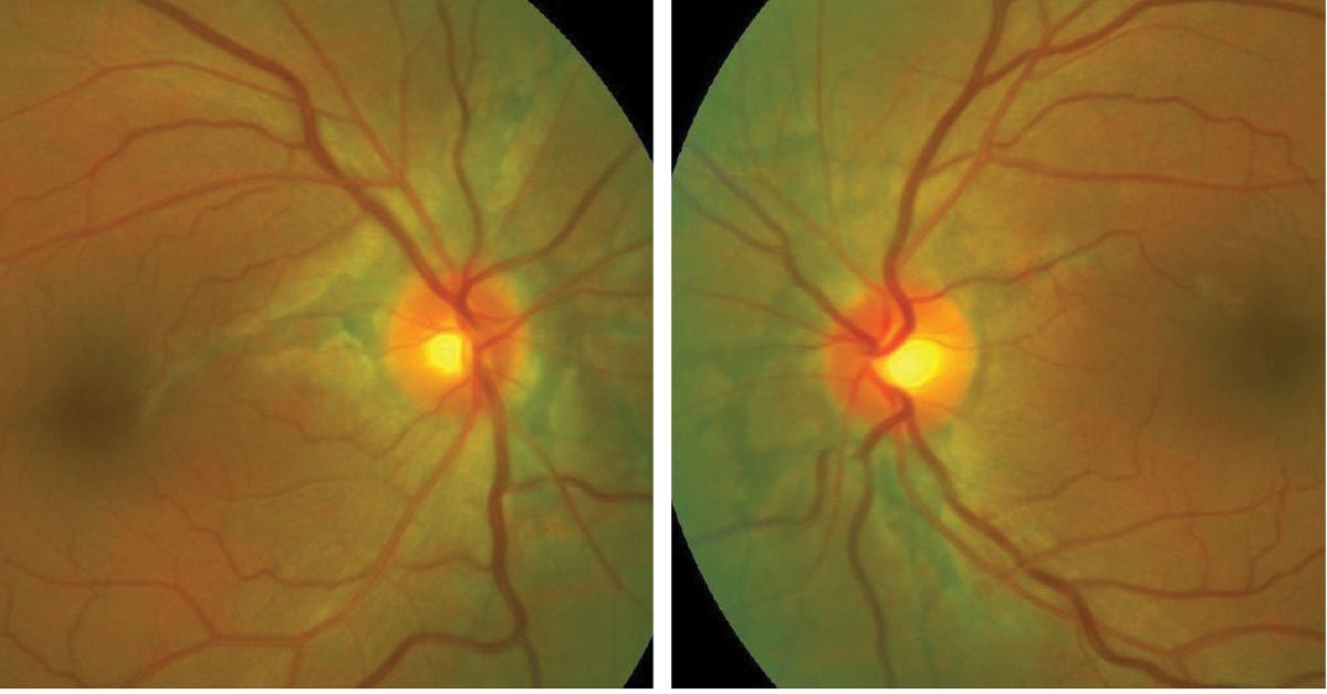 Fundus appearance of the patient's right and left eyes.