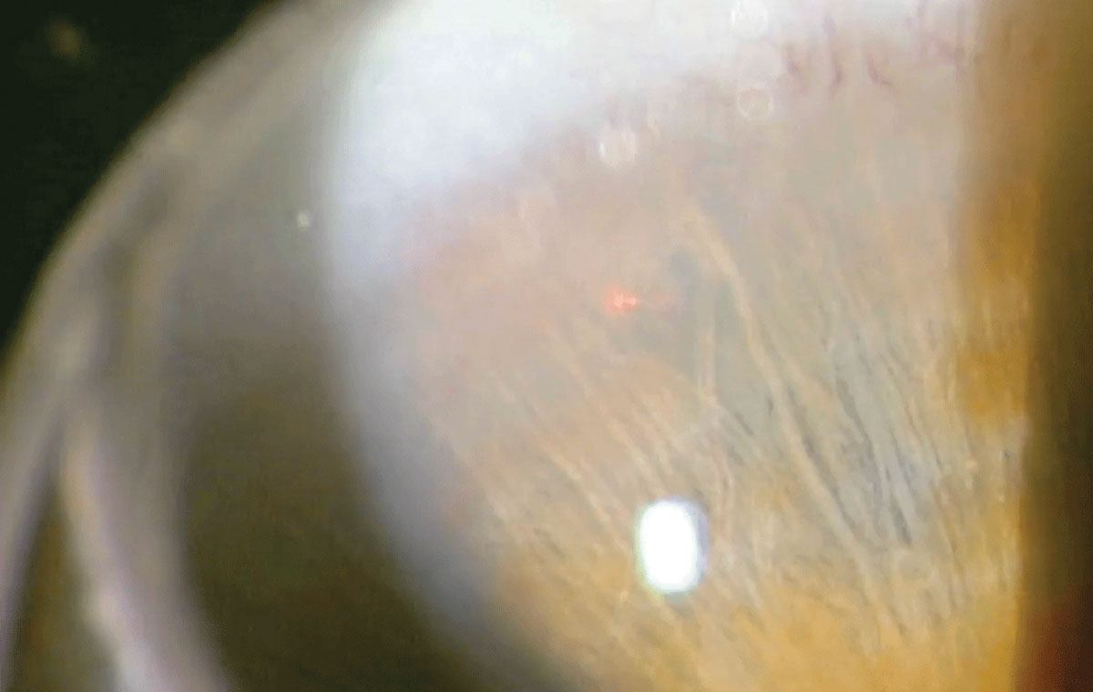 LPI may provide a solution for those at high risk of developing primary angle closure.