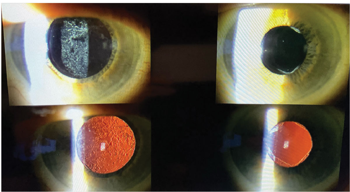 The photos on the left show the pre-op appearance of a patient with grade 3 posterior capsule opacification. The right two photos reveal the post-op appearance after a YAG capsulotomy was performed by an optometrist, showing perfect clearing of the posterior capsule.