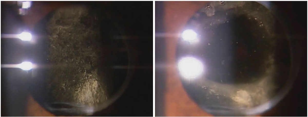 Posterior capsular distension syndrome before and after Nd:YAG capsulotomy.