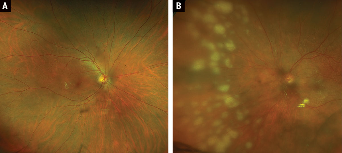 Fig. 1. Widefield optos fundus photograph of right and left eyes.
