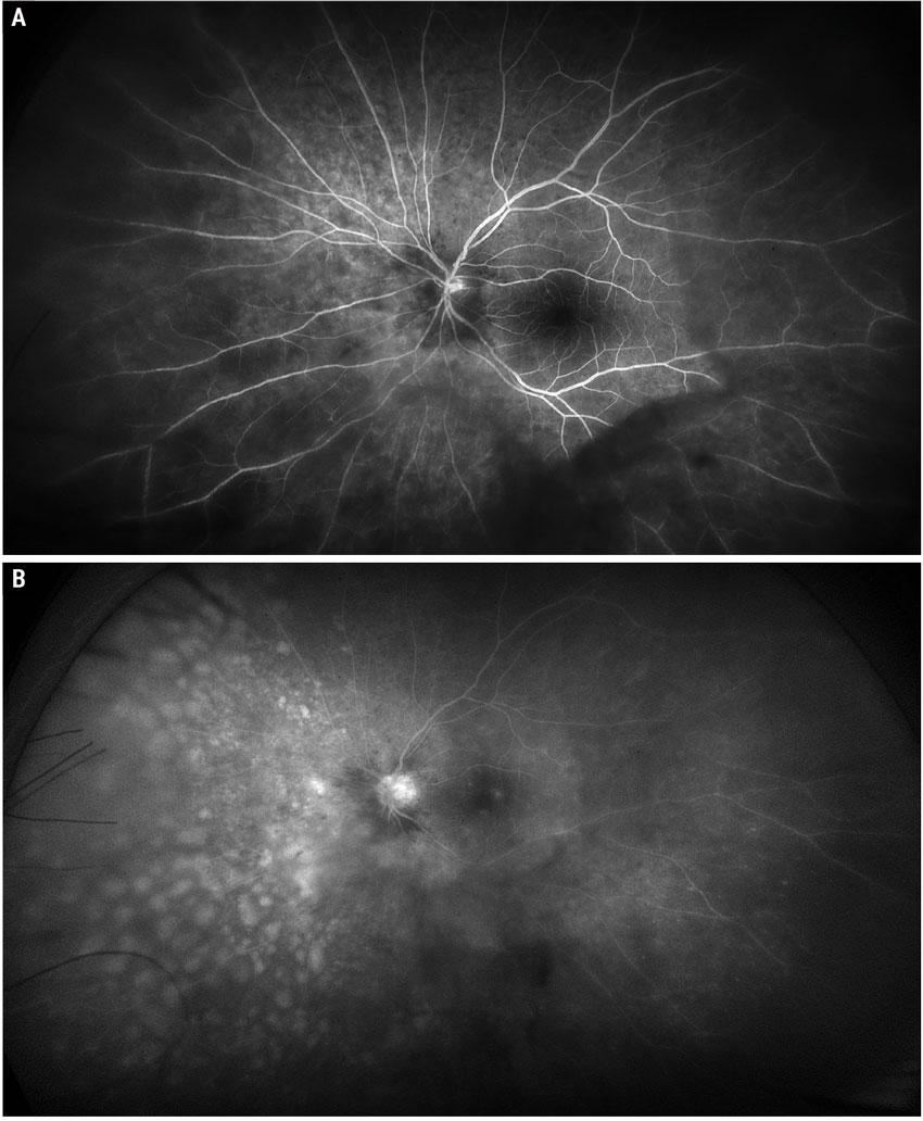 Fig. 2. Widefield Optos fluorescein angiogram early and late phase of the left eye.