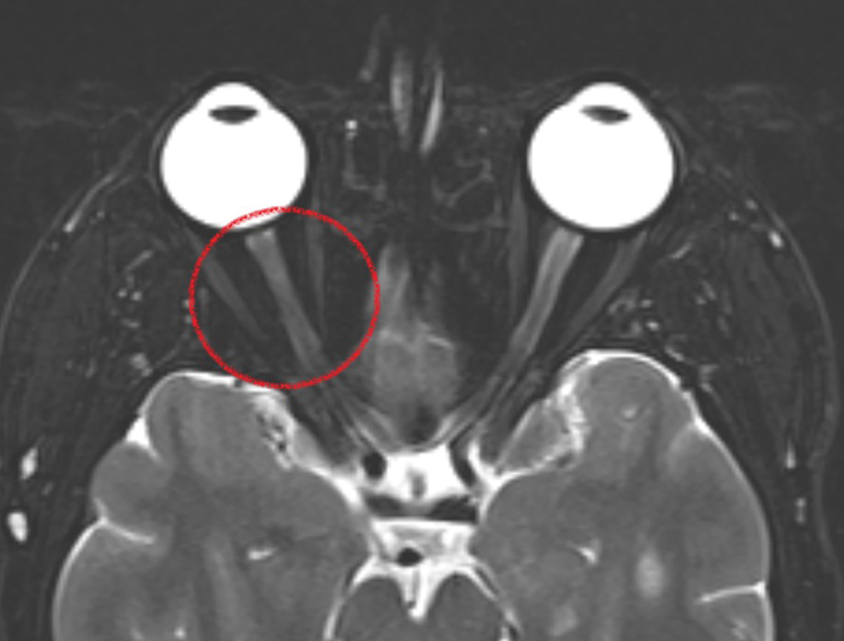 Optic neuritis