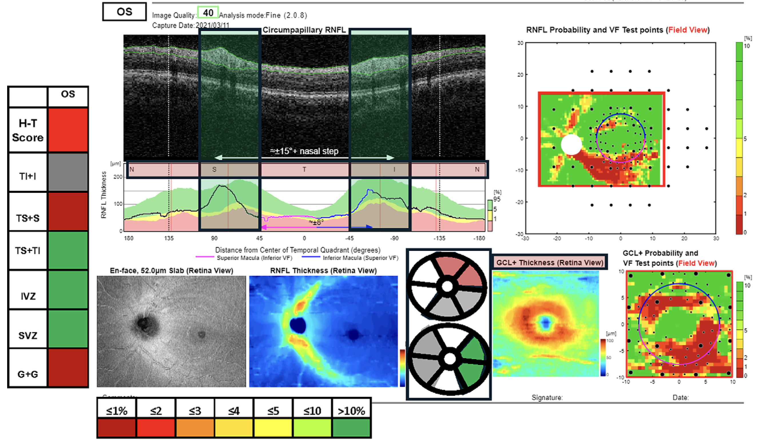 The H-T score was developed based on six individual variables of cpRNFL and GCL+IPL regional thickness, which were combined into a single metric with logistic regression analysis. In time, commercial release of this metric may allow the popular Hood Report to gain additional precision. This image from the study shows a modified version of the Hood Report that includes the percentile based on a real-world reference database of each of the six variables in the H-T model. 