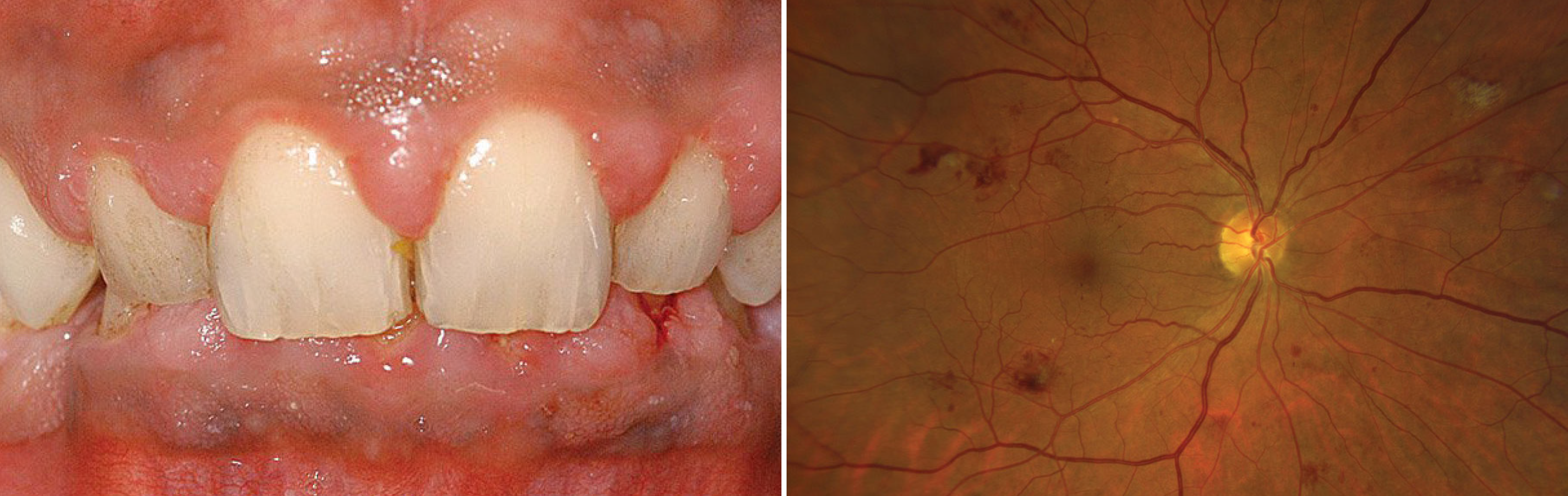 Shared inflammation pathways may explain the link between periodontitis and DR, but further research is needed to determine how strong the connection is or if this applies to all diabetic patients.
