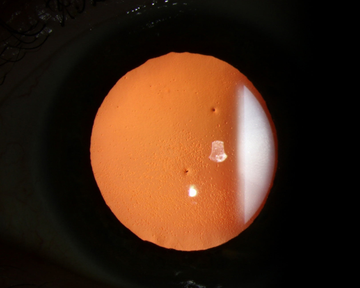 Fuchs’ dystrophy may be linked with more positive mental health outcomes because those with the disorder know that an effective and less invasive treatment is available, progression of the condition is gradual and slow and also because of the relatively older age at which Fuchs’ becomes problematic and/or causes isolation when compared with corneal diseases associated with systematic conditions. 
