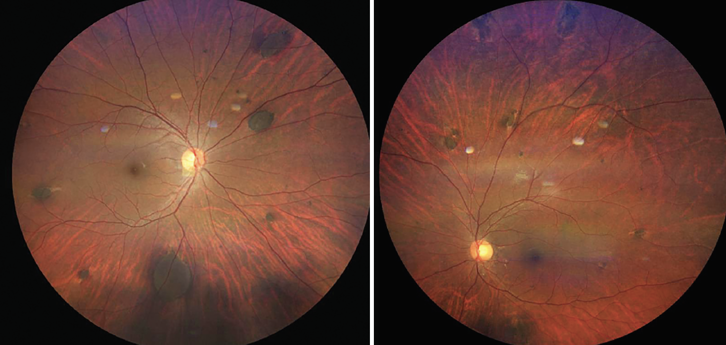 A patient with Gardner’s syndrome.
