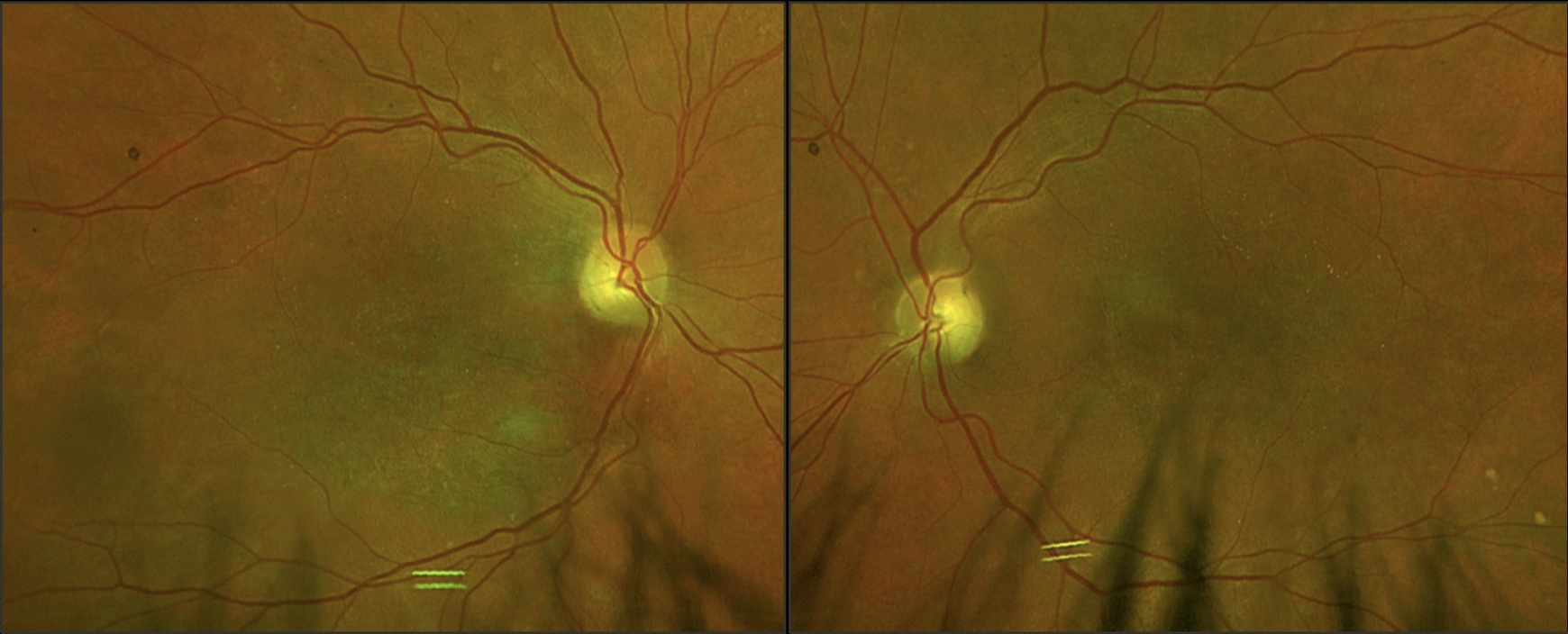 Image 1: Fundus photos of OD (left) and OS (right) acquired on Optos. Note the scattered small hard drusen-like deposits around the arcades and general macular depigmentation with mottling.