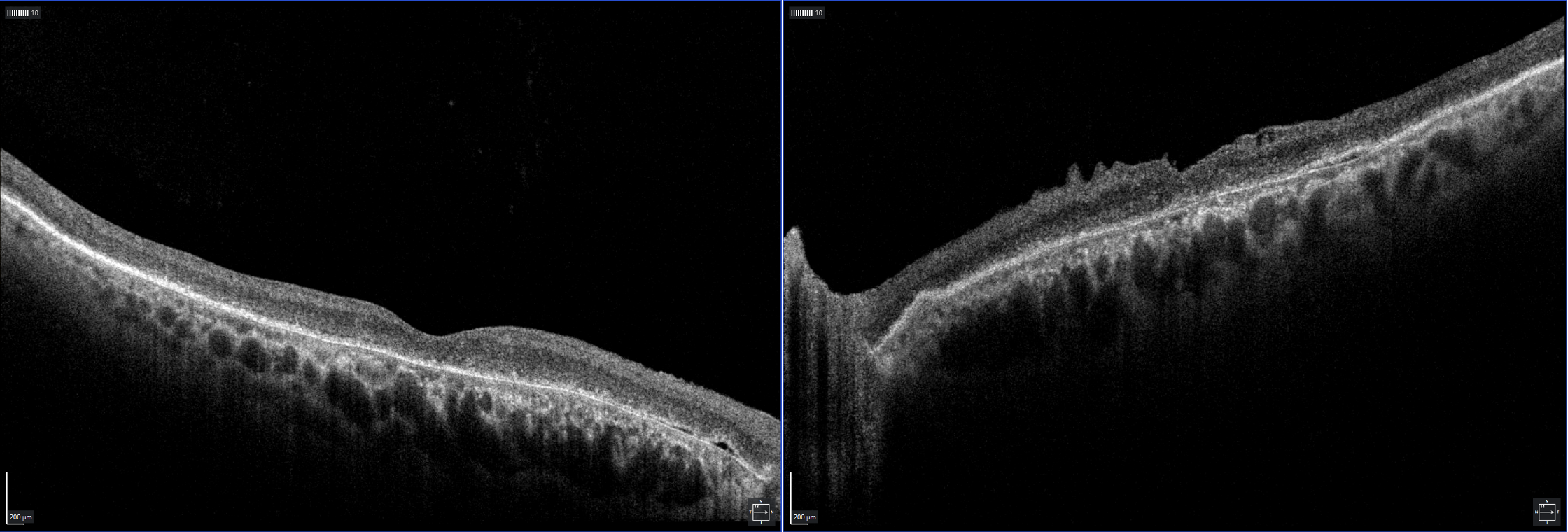 Image 2: OCT of macula OD (left), OS (right) displaying general atrophy of the outer retinal layers and shallow PEDs. An incidental ERM is noted OS. 
