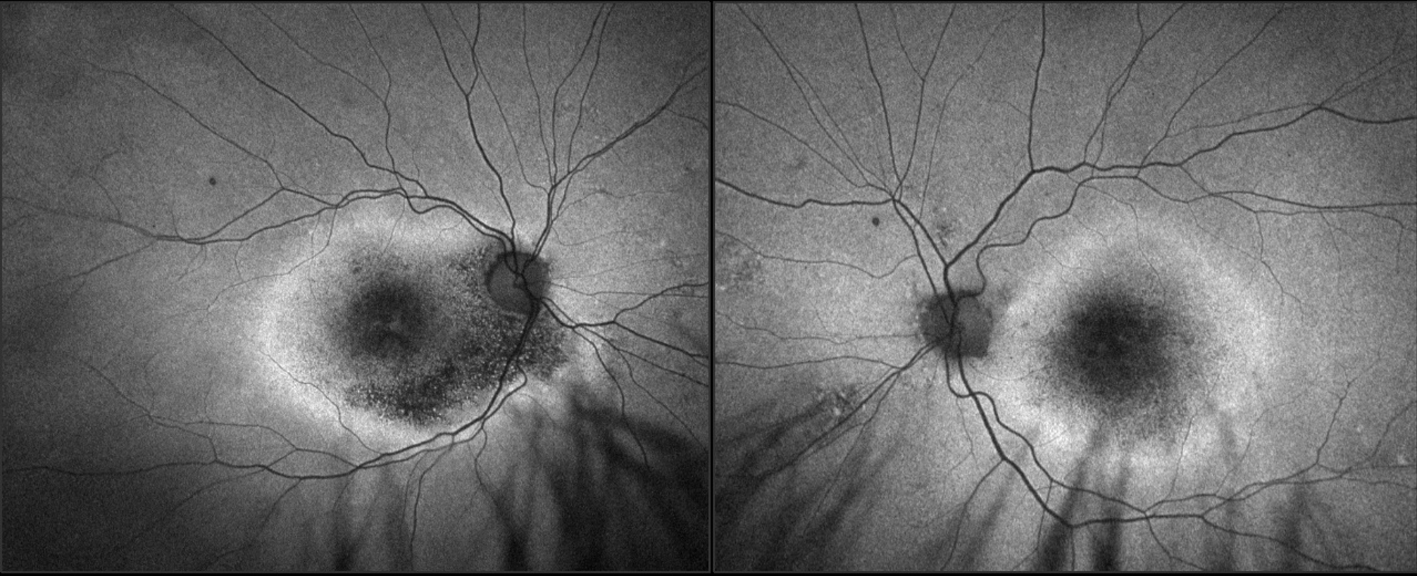 Image 3: FAF imaging acquired with Optos of OD, OS. Note significant hypofluorescence OU, with distressed RPE surrounding concentrically noted by hyperfluorescence. The appearance is symmetric between the eyes, with slightly more hypofluorescence OD. 
