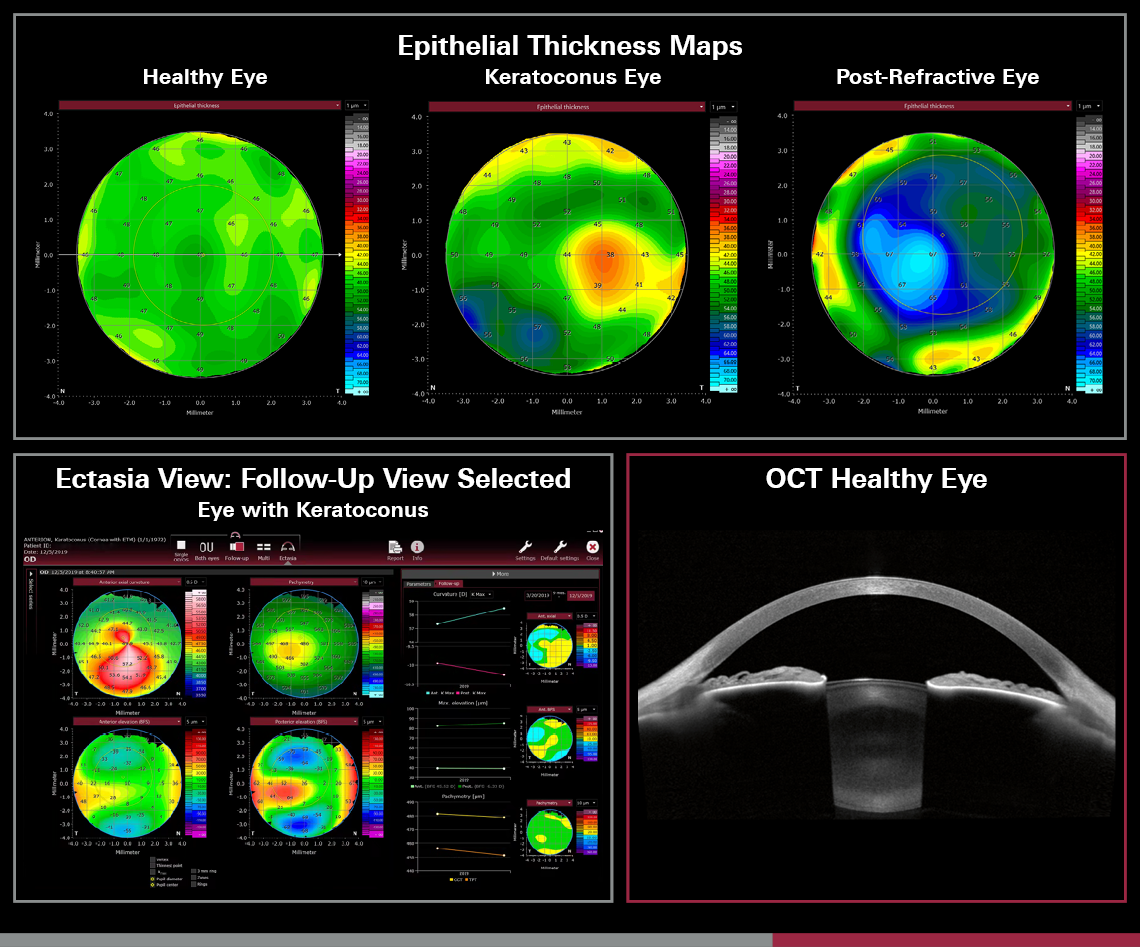Starting next month, eyecare providers who own a Heidelberg Anterion OCT will be able to add a module to their devices that enables precise measurement and mapping of the epithelium and stroma. As the latest addition to the device’s “Cornea App,” the epithelial thickness module is designed to aid in pre- and postoperative assessments for refractive procedures, as well as in the diagnosis and monitoring of corneal diseases such as keratoconus, the company says.
