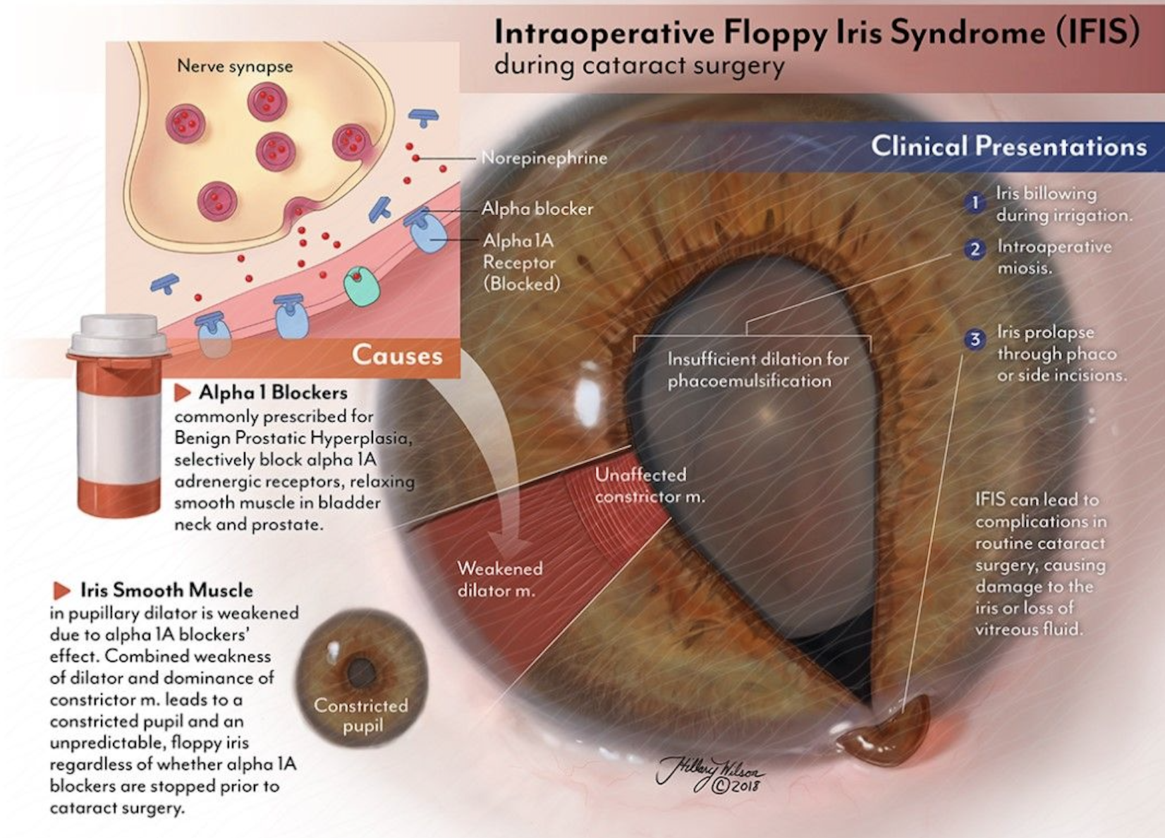 Three months of treatment with tamsulosin, often prescribed to patients with benign prostatic hyperplasia, was found to significantly reduce iris DMR thickness, DMR/SMR ratio, pre-dilation photopic pupil diameter and post-dilation pupil diameter. Since intraoperative floppy iris syndrome is more common among users of this medication, researchers advise monitoring iris thickness and pupil diameter changes before cataract surgery.