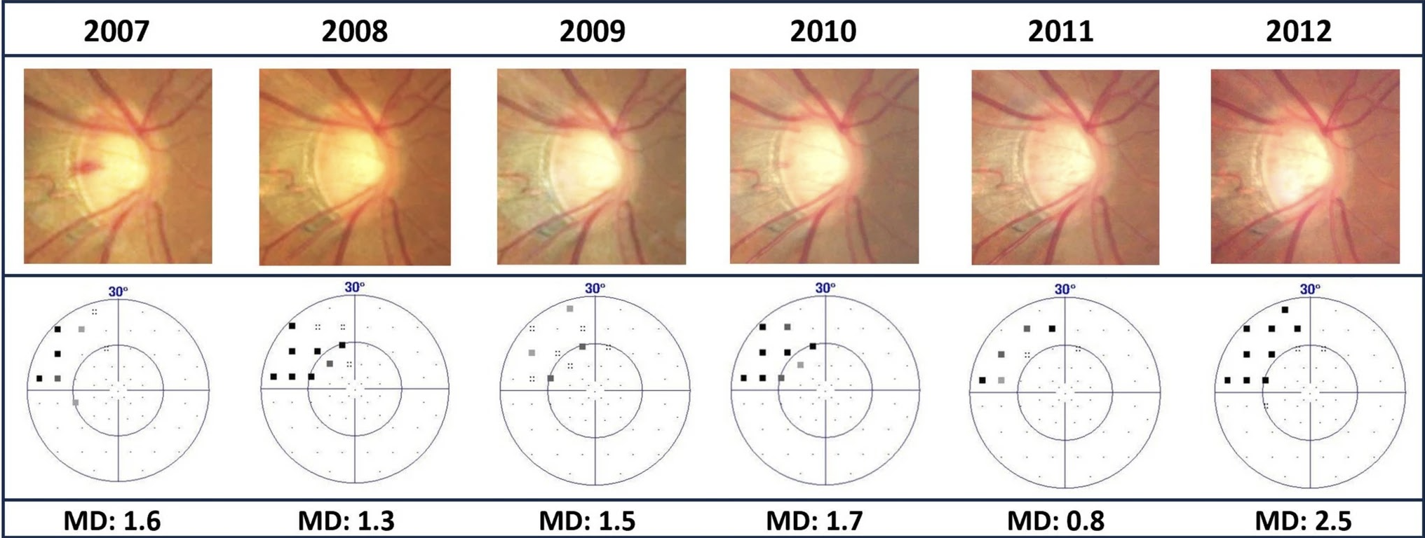 In this study on patients with myopic open-angle glaucoma, cases of inferior disc rotation had the most considerable progression in the superior peripheral region and vice-versa. 