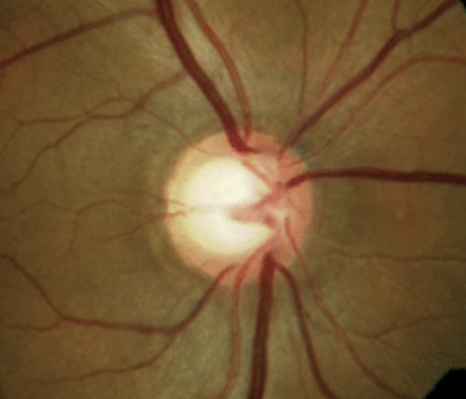 Eyes with physiological cupping only had a weak positive correlation between retinal nerve fiber layer and RPC VD in the superior quadrant, but normal eyes saw moderate positive correlations.
